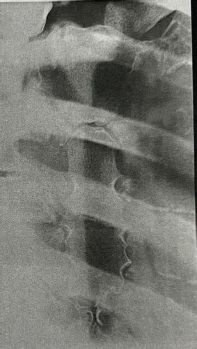 Radiographic Procedures Image Analysis Bony Thorax Flashcards Quizlet