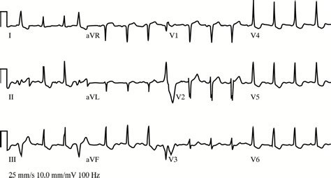 The Electrocardiographic Differential Diagnosis Of St Segment