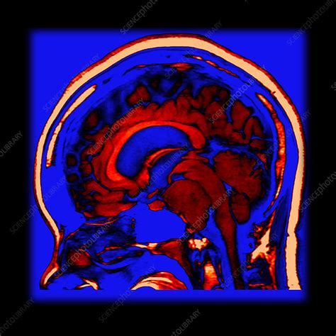 Enhanced Clival Meningioma On Mri Stock Image C0430448 Science