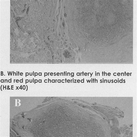 Microscopy Of Pulmonary Splenosis A Splenic Tissue Characterized With