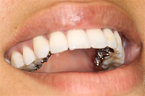 Lingual Braces