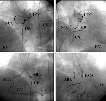 Catheter Ablation Of Ventricular Arrhythmias Originating In The