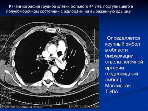 Диагностика тромбоэмболии легочной артерии (ТЭЛА) - презентация онлайн