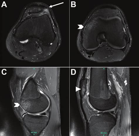 Fat Saturated T2 Weighted Axial A B And Sagittal C D Magnetic