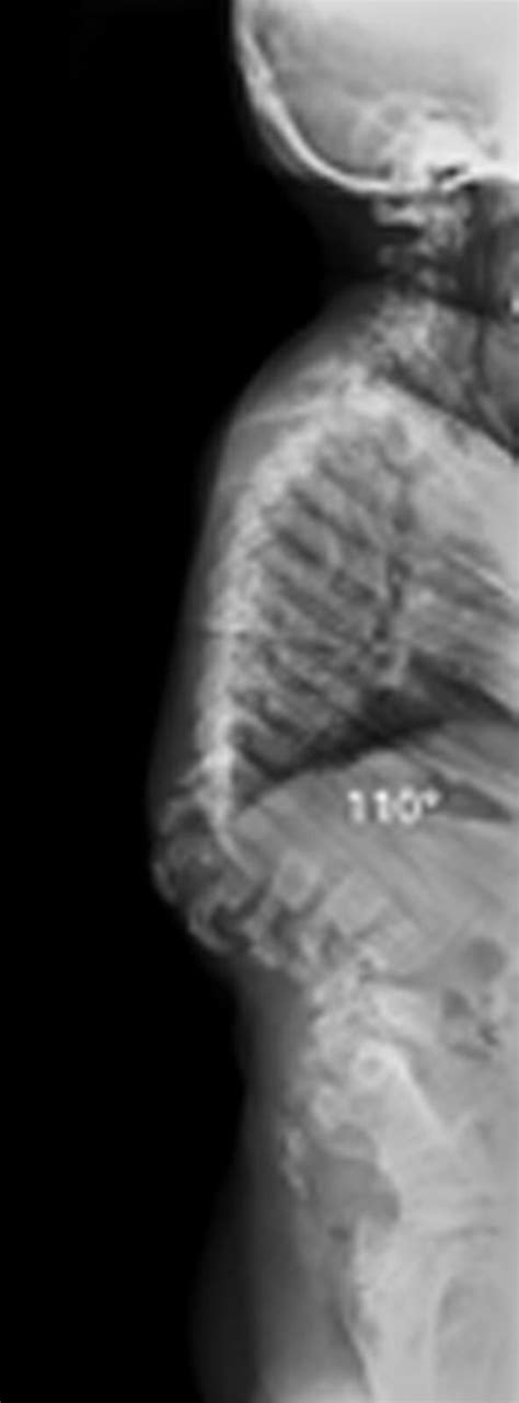 Thoracolumbar Kyphosis In Patients With Mucopolysaccharidoses Bone