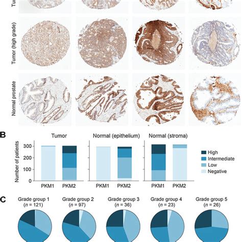 PKM1 And PKM2 Expression In Normal And Cancerous Human Prostate Tissue