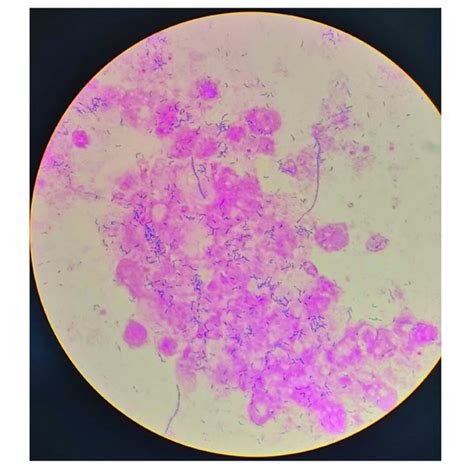 Gram Stain Of The Bronchoalveolar Lavage Fluid Download Scientific Diagram