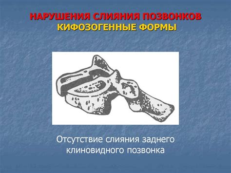Аномалии развития позвоночника - презентация онлайн