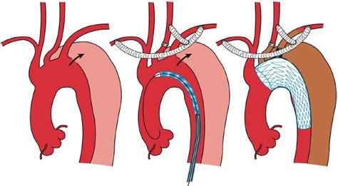 Endovascular Repair Of Descending Thoracic Aortic Aneurysms Advances