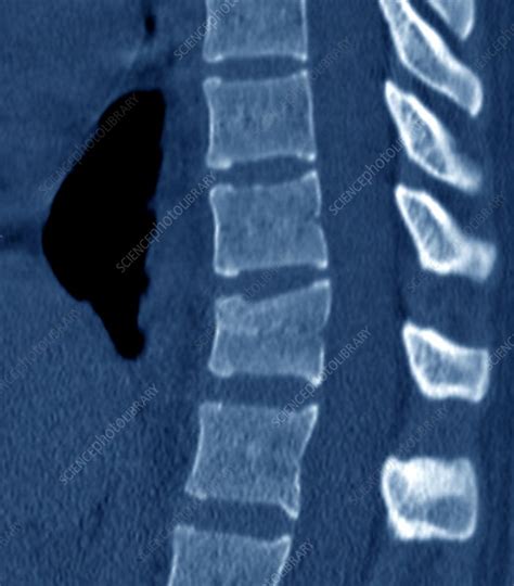 Thoracic Spine Fracture Ct Scan Stock Image C Science