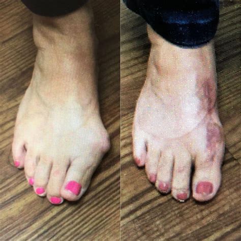 Bunions Foot Problems What Is A Bunion Sole Bliss Atelier Yuwa Ciao Jp