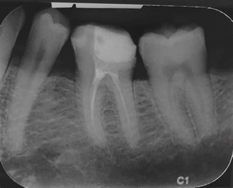 Preoperative Radiograph Of Tooth In Oblique Mesial Projection