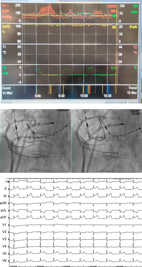 Metaraminol Induced Coronary Vasospasm Masquerading As St Elevation