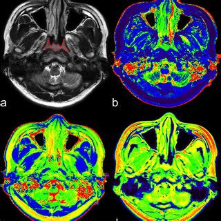 SyMRI Of A 48 Year Old Male NPC Patient A Axial T2WI Shows Uniform