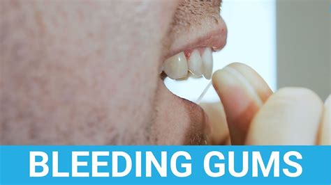 Bleeding Gums When Brushing Teeth Youtube