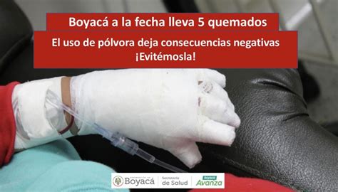 Aumentan los casos de quemados por pólvora en Boyacá Gobernación de