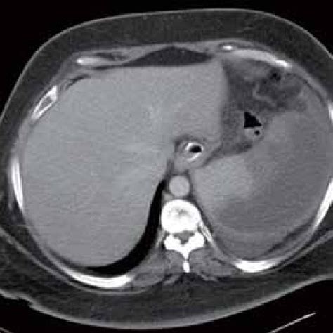 Ct Scan Showing Evidence Of Splenic Infarction Complicated By Abscess Download Scientific