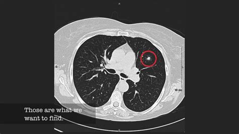 Lung Cancer Screening Ct Report Template - prntbl ...