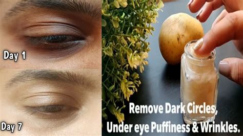 I Removed Dark Circles In Days With Potato Eye Gel Remove Under Eye