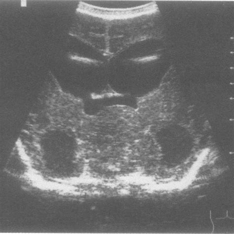 Moderate enlargement of the left and right ventricle in a coronal ...