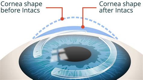 Keratoconus treatment - The Eye Practice