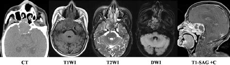 Figure From Imaging Features Of Myoepithelial Carcinoma In The