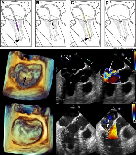 First In Human Transfemoral Transseptal Mitral Valve Chordal Repair