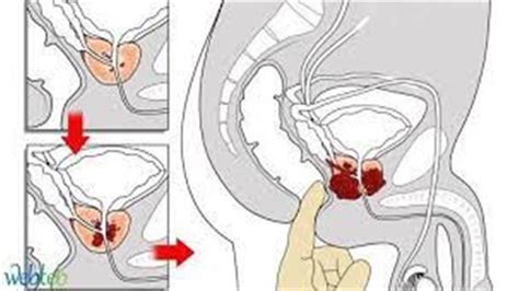 سرطان البروستاتا 10 علامات عند ظهورها يجب زيارة الطبيب فور مصراوى