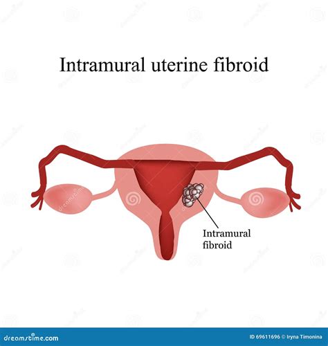 Intramural Uterine Fibroid Stock Illustrations 18 Intramural Uterine