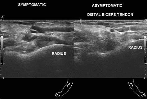 Distal Biceps Tendon Rupture Image