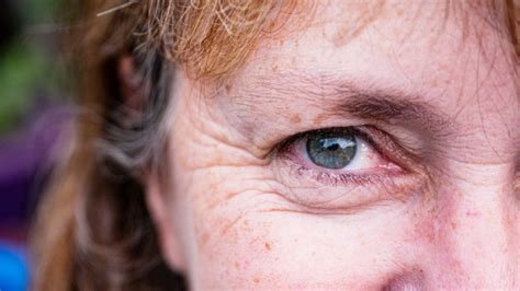 Lines Under the Eyes: Causes, Treatment, and Prevention