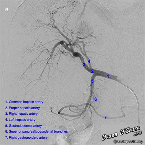 Gastroduodenal artery | Radiology Reference Article | Radiopaedia.org ...