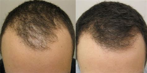 Finasteride Before And After Photos 2025