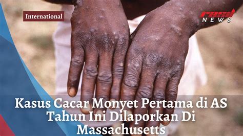 Kasus Cacar Monyet Pertama Di AS Tahun Ini Dilaporkan Di Massachusetts