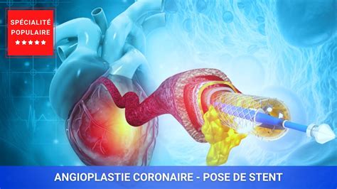 Angioplastie Coronaire Pose De Stent YouTube