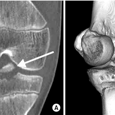 A Associated Anterior Cruciate Ligament Injury With Segond S Fracture