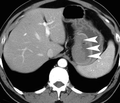 Gastrointestinal Stromal Tumors Clinical Radiologic And Pathologic