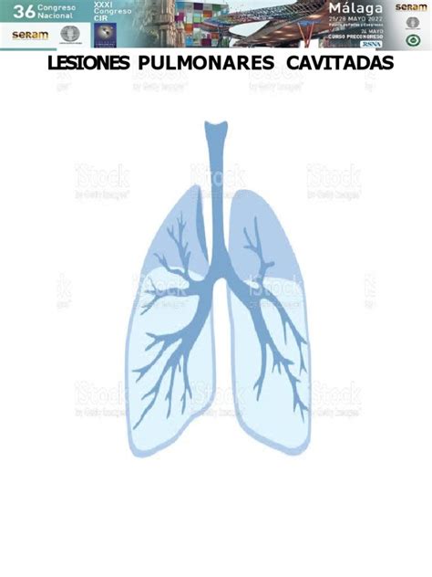 Lesiones Cavitadas Aereas Pulmonares R2 Pdf Tos Tuberculosis