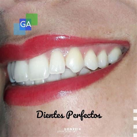 ¿los Dientes Perfectos Realmente Existen 2022