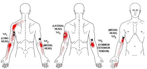 The Definitive Guide to Triceps Brachii Anatomy, Exercises & Rehab