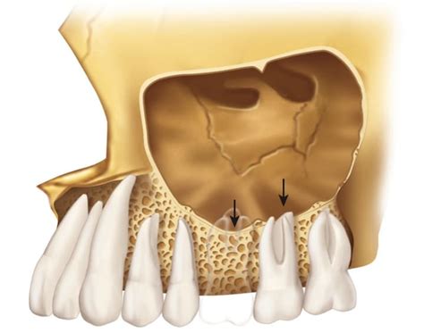 Dental Implant Perforated Sinus Common Symptoms Common Symptoms