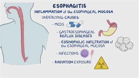 Esophagitis Clinical Sciences Osmosis Video Library