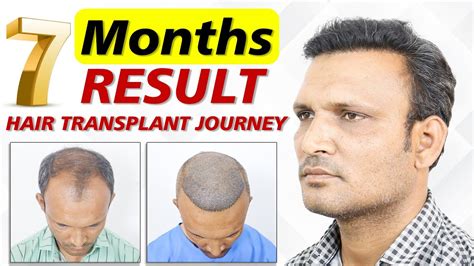 Hair Transplant Result In Bhopal Grade Nw 6 Baldness 4500 Grafts