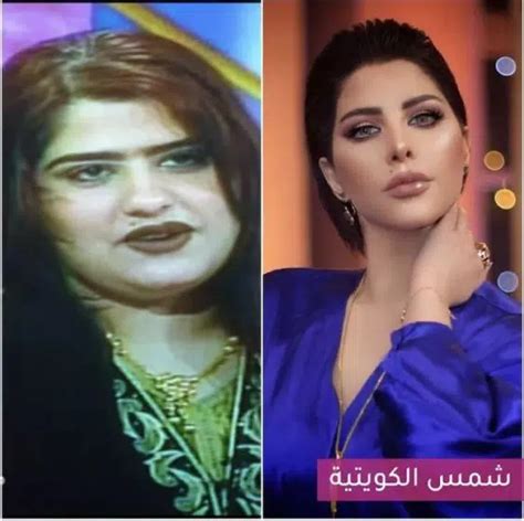 الفنانة الكويتية أمل العوضي تظهر بساق واحدة وتثير حيرة الجمهور شاهد