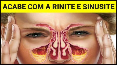 Sinusite Consulta Otorrino Consulta Otorrinolaringologista Em