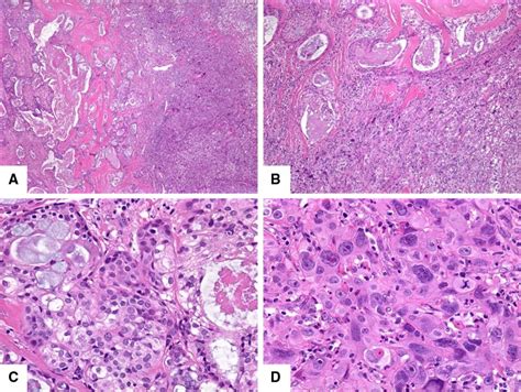 High Grade Transformation Of Low Grade Mucoepidermoid Carcinoma A Download Scientific Diagram