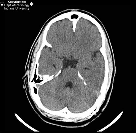 Neuroradiology On the Net: Gorlin-Goltz syndrome