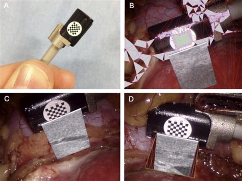 Intraoperative Ultrasound Overlay In Robot Assisted Partial Nephrectomy