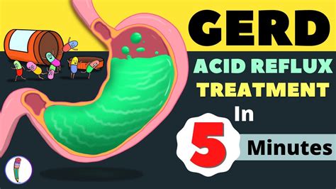 Gerd Treatment Acid Reflux Treatment Heartburn Treatment All You Need To Know Youtube