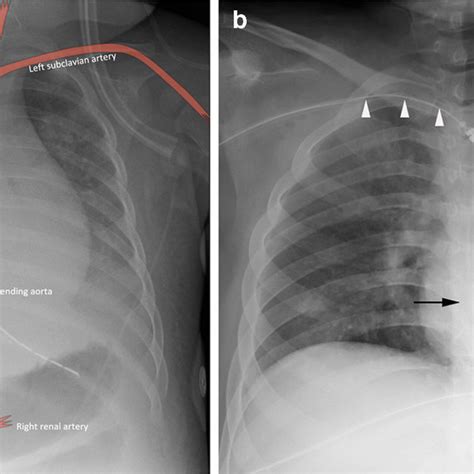 Malpositioned Umbilical Venous Catheter Uvc In A 6 Day Old Girl Download Scientific Diagram